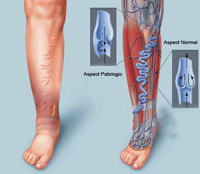 boli vasculare periferice ocluzive picioare dureri în vene la picioare