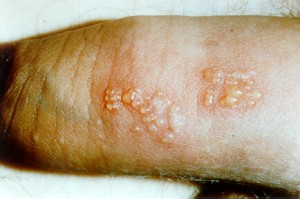 Herpes Genital Barbati
