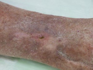 Ulcer Varicos Dupa-2 Ulcer Varicos Dupa-2