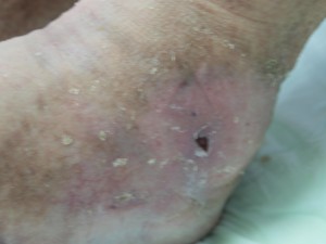 Ulcer Varicos Dupa-4 Ulcer Varicos Dupa-4