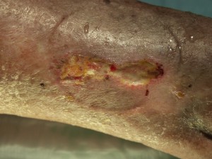 Ulcer Varicos Inainte-1 Ulcer Varicos Inainte-1