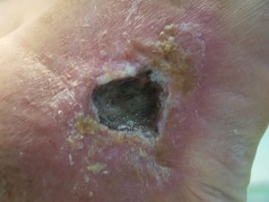 Ulcer Varicos Inainte-3 Ulcer Varicos Inainte-3