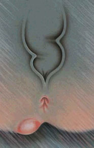Abces Anal