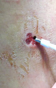 Biopsie Cutanata
