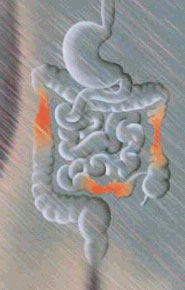 Boala Crohn