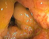 Boala Crohn Boala Crohn