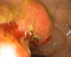 Cancer colonic Cancer colonic