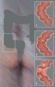 Cancer de Colon
