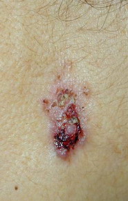 Carcinom Bazocelular