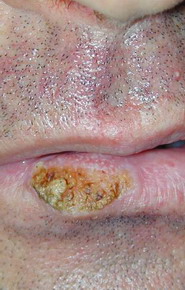 Carcinom Spinocelular