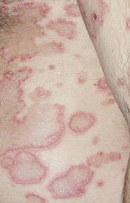 Dermatita Herpetiforma