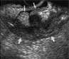 Diverticul colon sigmoid-2 Diverticul colonic