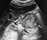 Diverticul colonic Diverticul colonic