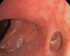 Diverticul colonic Diverticul colonic
