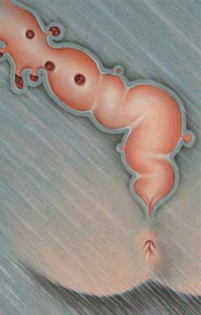 Diverticuloza