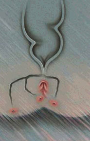 Fistula Perianala