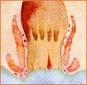 Fisura Anala