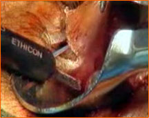 Hemoroidectomia Harmonic Scalpel