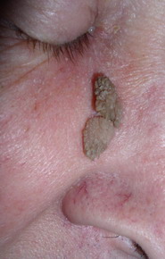 Papiloame Cutanate