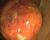 Polip colonic Polip colonic
