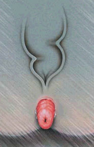 Prolaps Rectal