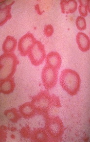 Urticaria