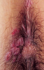 Vegetatii Veneriene
