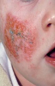 Dermatita Atopica Dermatita Atopica