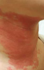 Dermatita de Contact
