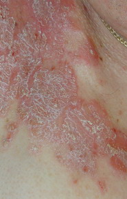 Despre Psoriazis