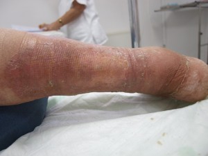 Ulcer varicos dupa tratament Ulcer varicos dupa tratament