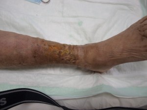 Ulcer varicos dupa tratament Ulcer varicos dupa tratament