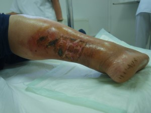 Ulcer varicos inainte tratament Ulcer varicos inainte tratament
