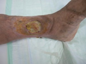 Ulcer varicos inainte tratament Ulcer varicos inainte tratament
