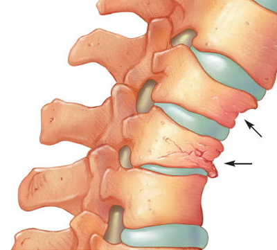 Tratamentul cartilajului la nivelul coloanei vertebrale