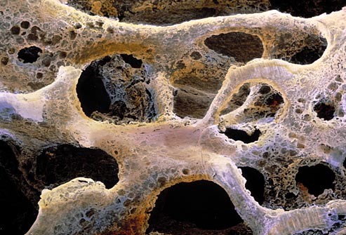 Ca urmare a osteoporozei, oasele formeaza o structura poroasa anormala, compresibila, ca un burete