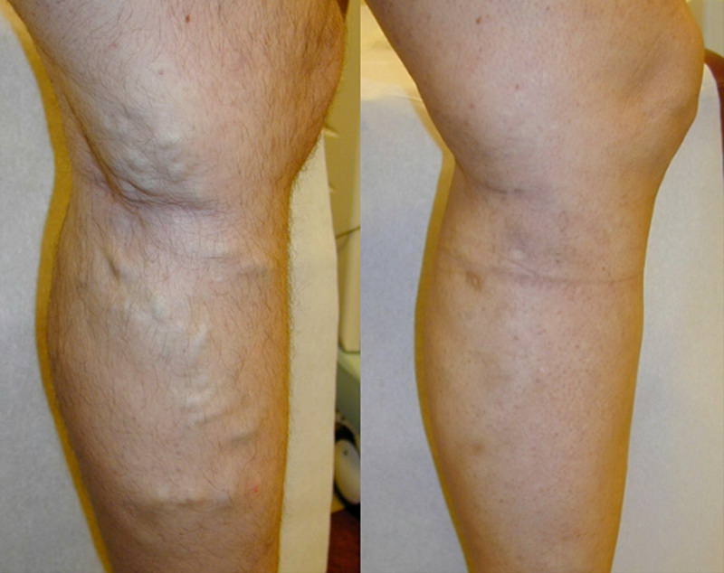Sindromul picioarelor neliniÈtite: simptome, cauze Èi tratament