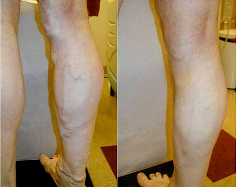 Tratament cu remedii populare pentru varice la picioare la bărbați