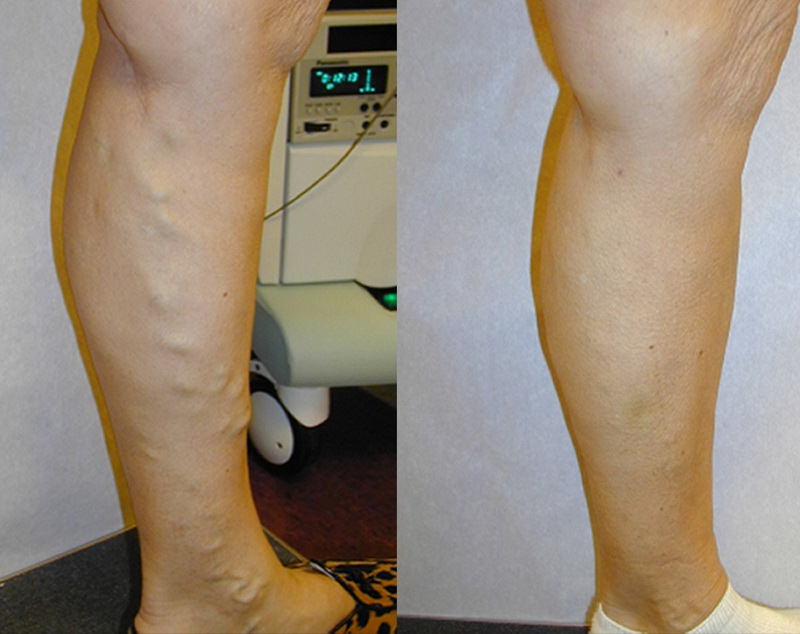 tratamentul picioarelor varicoase interne varicoza stadiul iniial mazi tratament