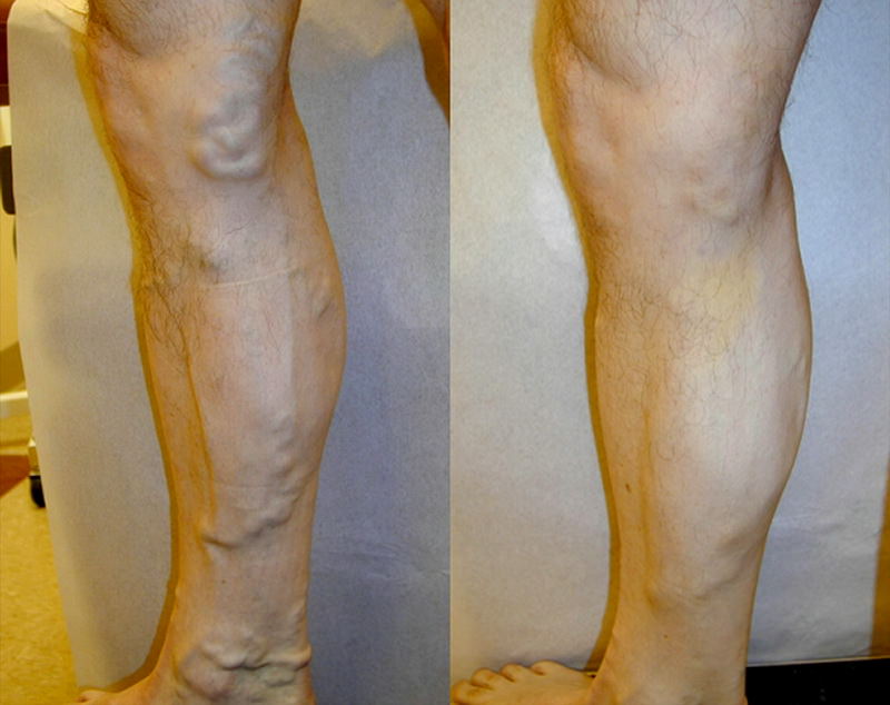 Picior în bombat dureroasă - Tratamentul operațional al venelor varicoase ale venei pe picioare