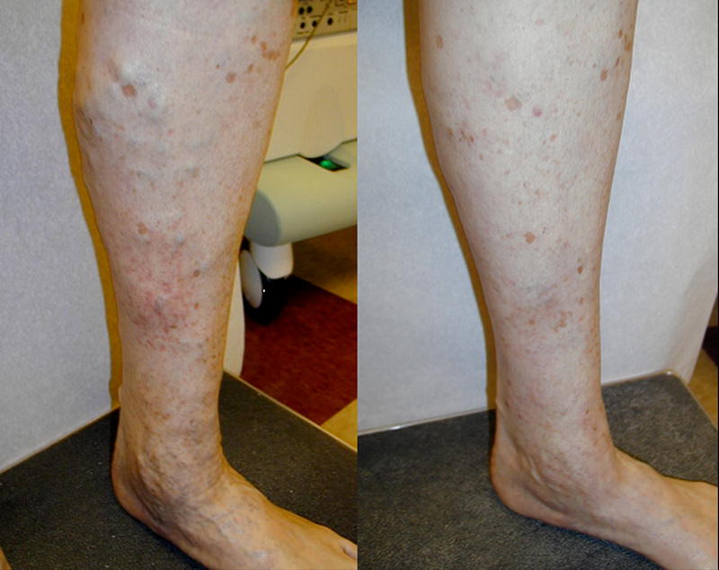 picioare înainte i dupa îndepartarea varicelor varicoza masaj