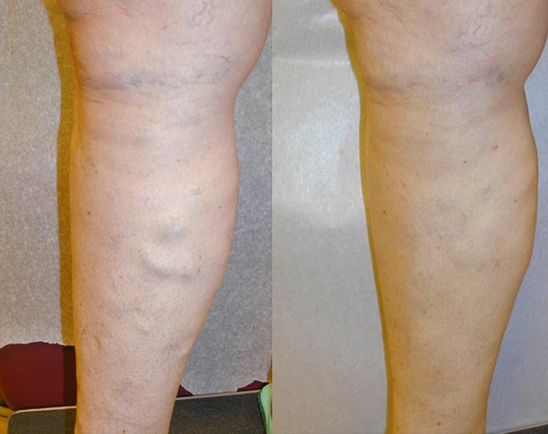 scleroterapie fotografie înainte și după varicoză