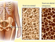 Analize pentru osteoporoza » LaurusMedical - hemoroizi, varice, dermatologie, gastroenterologie