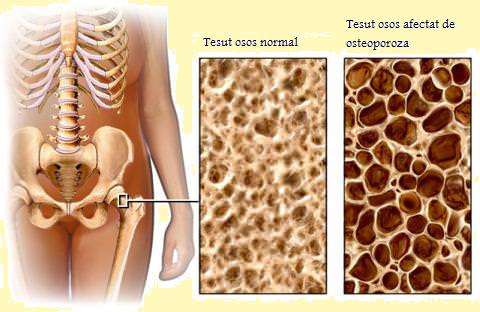 Ce este osteopenia, cauzele, simptomele caracteristice, tratamentul
