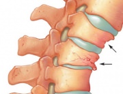 Atunci cand vertebrele sunt slabite, ele se pot fractura si tasa
