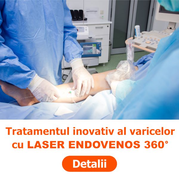 tratament varice laser