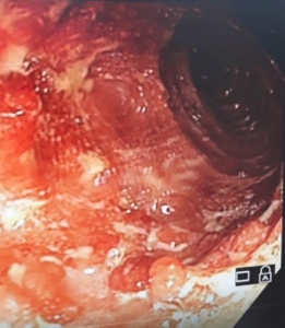 boala Crohn M 42 ani