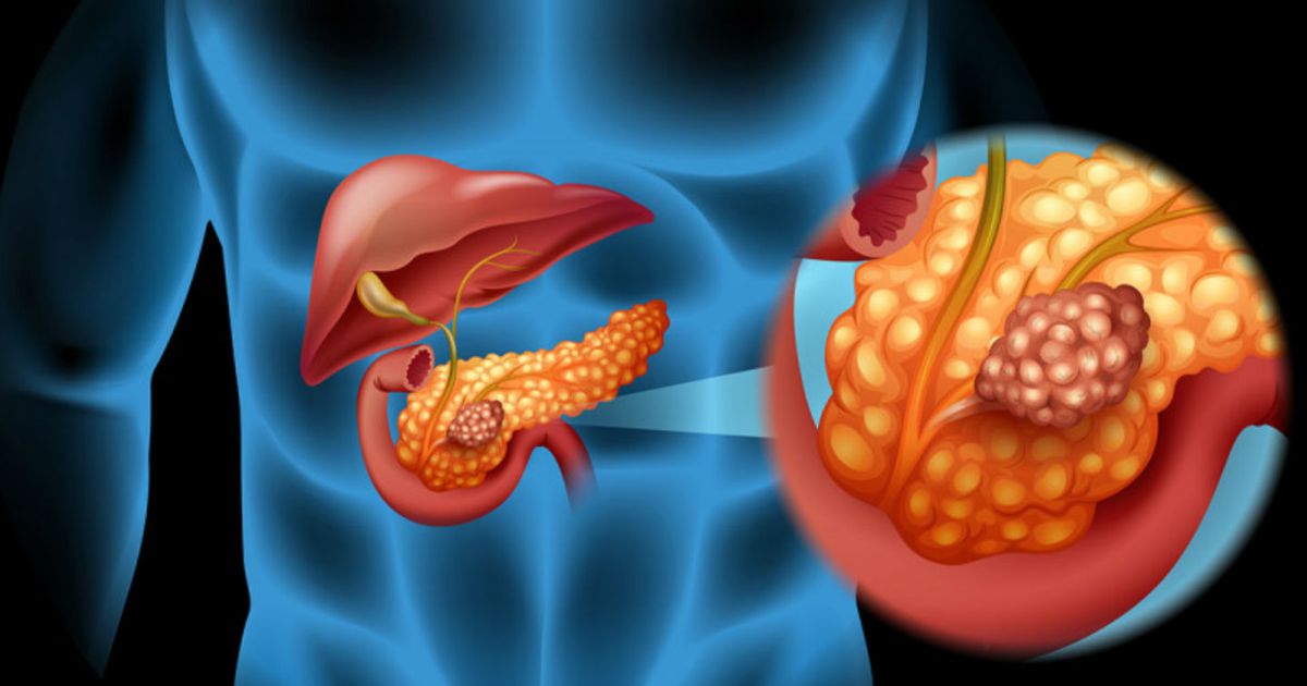 Cancerul pancreatic: simptome, factori de risc, metode de diagnosticare