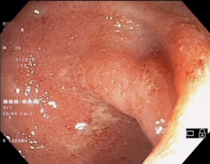 colita nedeterminata M 34 ani