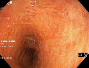 colita ulceroasa F 42 ani